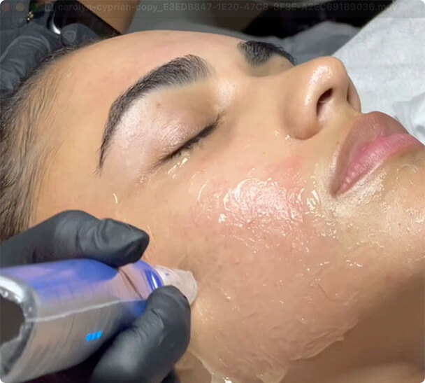 Smarter tech is the SkinPen® signature